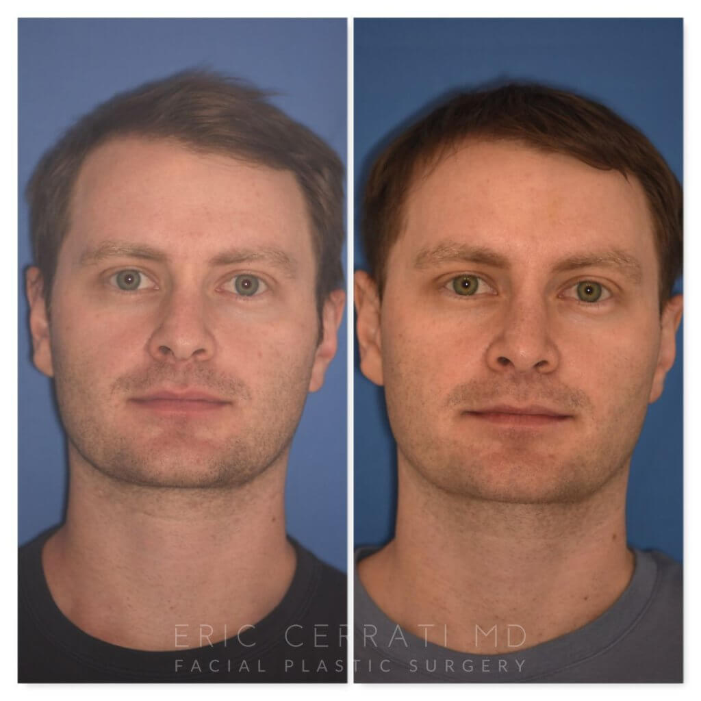 patient before and after rhinoplasty - 29 YR - 2 Months Postop: Rhinoplasty