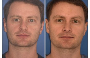 patient before and after rhinoplasty - 29 YR - 2 Months Postop: Rhinoplasty