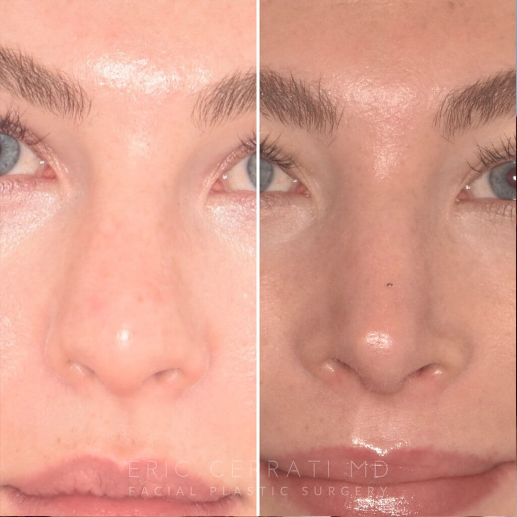 before and after rhinoplasty procedure