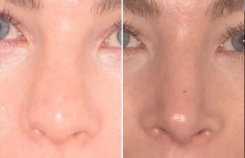 before and after rhinoplasty procedure