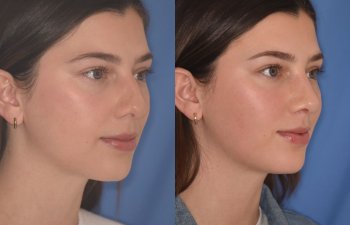 patient before and after rhinoplasty - 24 YR - 2 Months Postop: Rhinoplasty