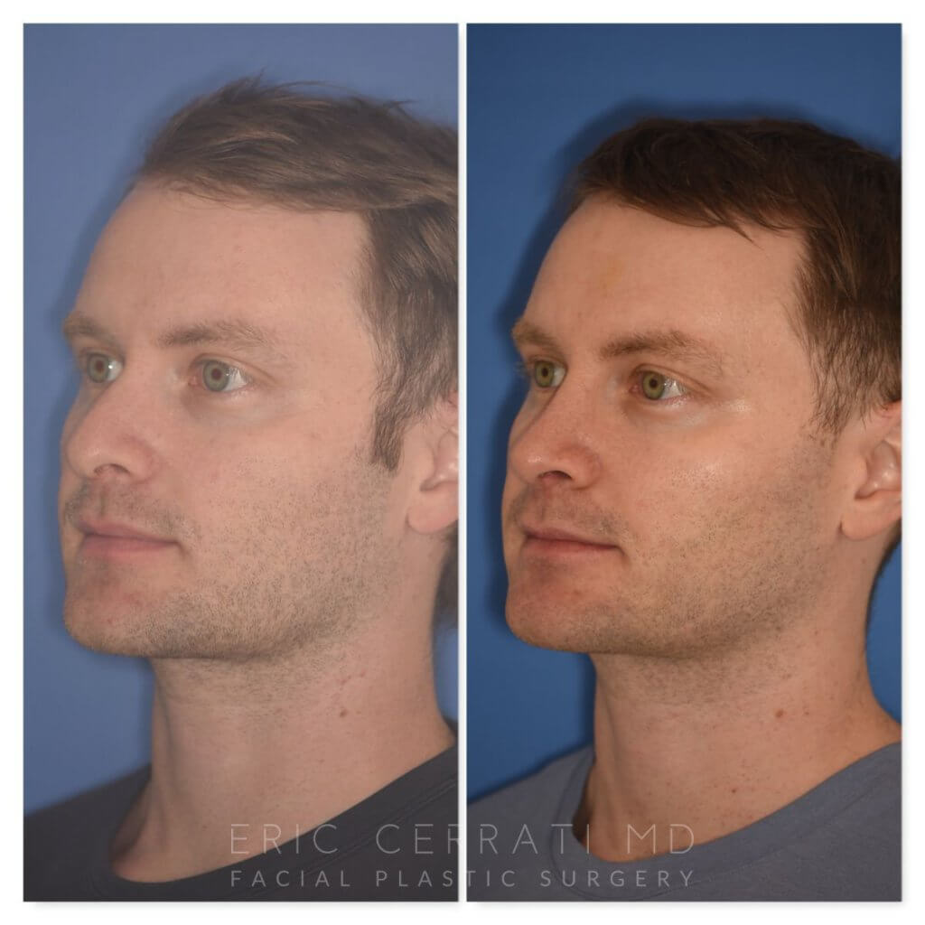 patient before and after rhinoplasty - 29 YR - 2 Months Postop: Rhinoplasty