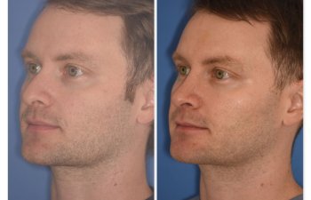 patient before and after rhinoplasty - 29 YR - 2 Months Postop: Rhinoplasty