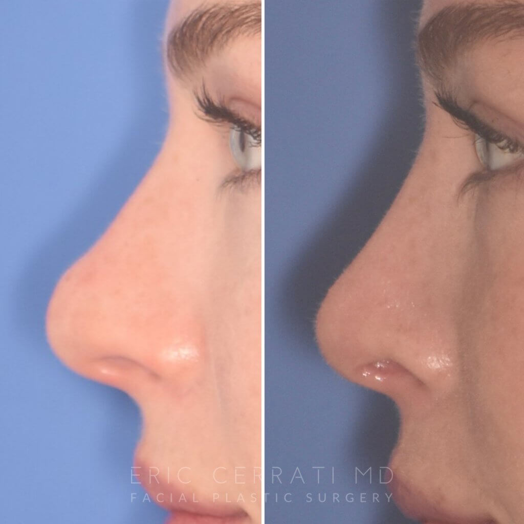 before and after rhinoplasty procedure