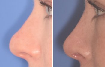 before and after rhinoplasty procedure