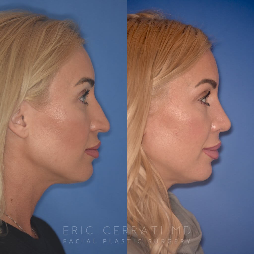 40 YR - 2 Months Postop: Rhinoplasty