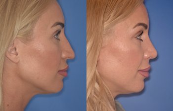 40 YR - 2 Months Postop: Rhinoplasty