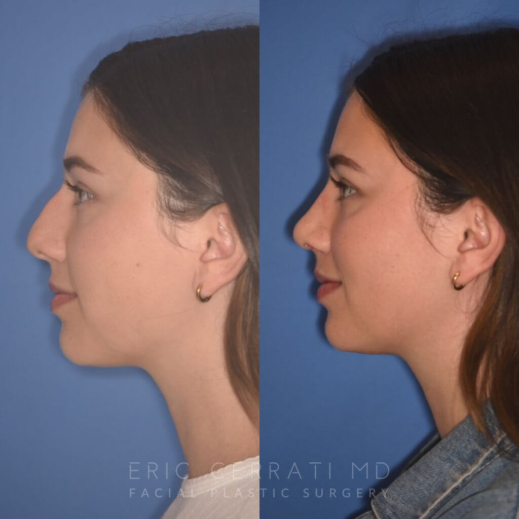 patient before and after rhinoplasty - 24 YR - 2 Months Postop: Rhinoplasty