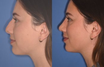 patient before and after rhinoplasty - 24 YR - 2 Months Postop: Rhinoplasty