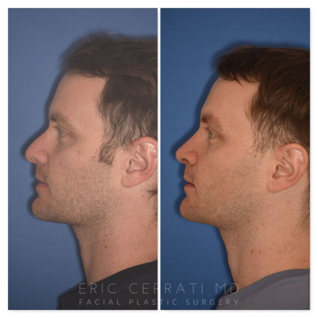 patient before and after rhinoplasty - 29 YR - 2 Months Postop: Rhinoplasty