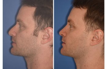 patient before and after rhinoplasty - 29 YR - 2 Months Postop: Rhinoplasty