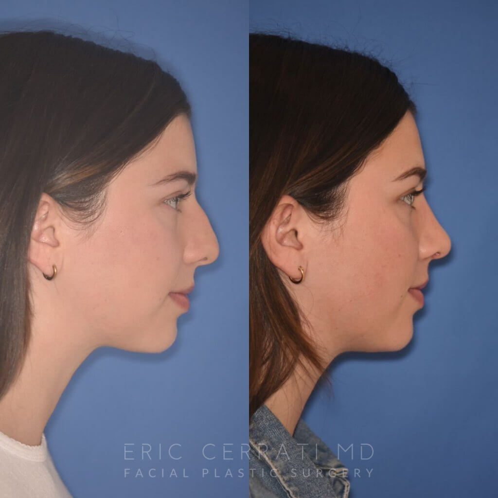 patient before and after rhinoplasty - 24 YR - 2 Months Postop: Rhinoplasty