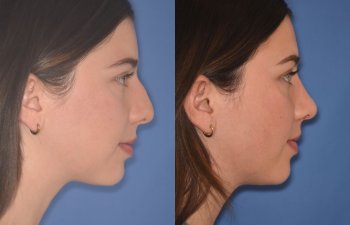 patient before and after rhinoplasty - 24 YR - 2 Months Postop: Rhinoplasty