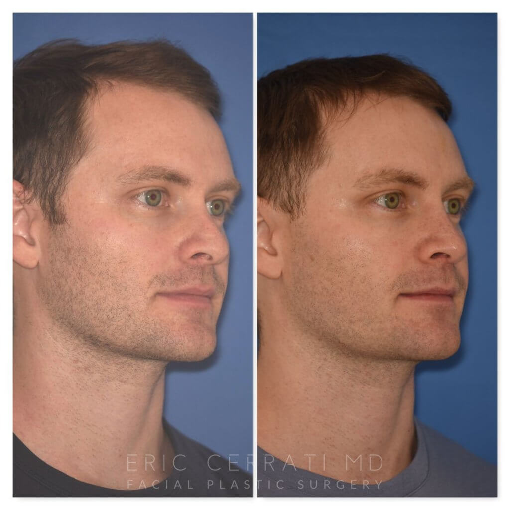 patient before and after rhinoplasty - 29 YR - 2 Months Postop: Rhinoplasty