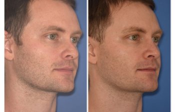 patient before and after rhinoplasty - 29 YR - 2 Months Postop: Rhinoplasty