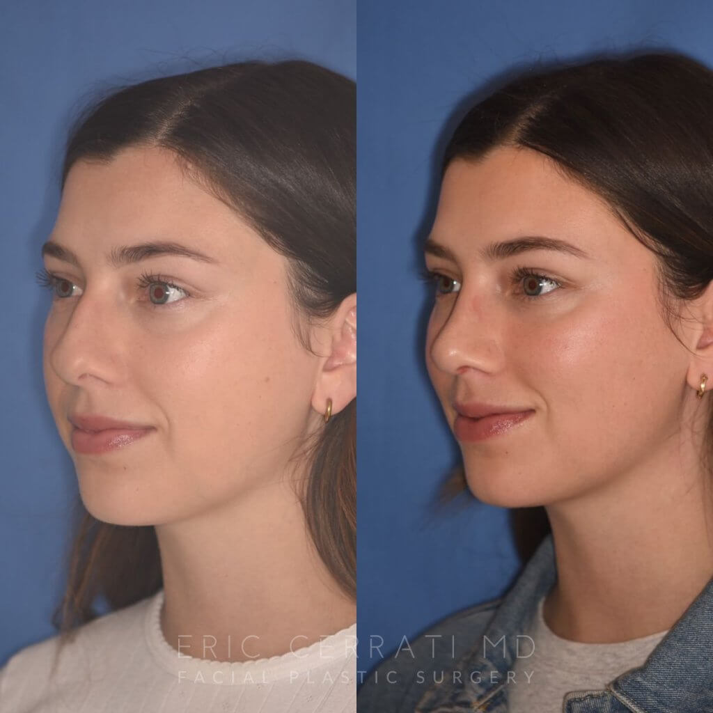 patient before and after rhinoplasty - 24 YR - 2 Months Postop: Rhinoplasty