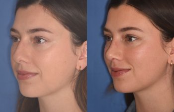 patient before and after rhinoplasty - 24 YR - 2 Months Postop: Rhinoplasty