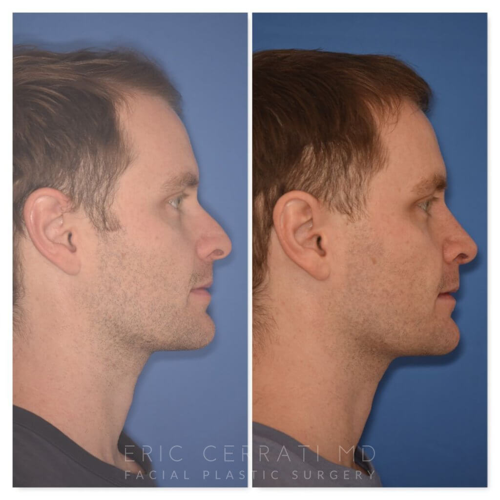patient before and after rhinoplasty - 29 YR - 2 Months Postop: Rhinoplasty