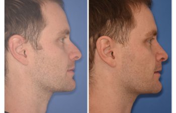 patient before and after rhinoplasty - 29 YR - 2 Months Postop: Rhinoplasty