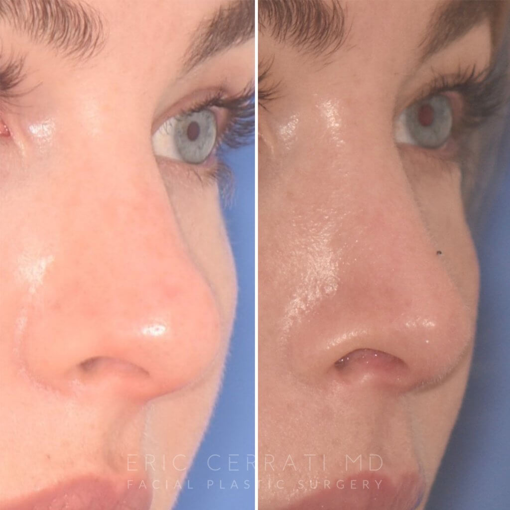 before and after rhinoplasty procedure