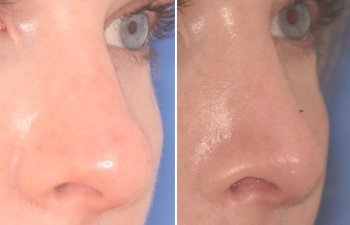 before and after rhinoplasty procedure