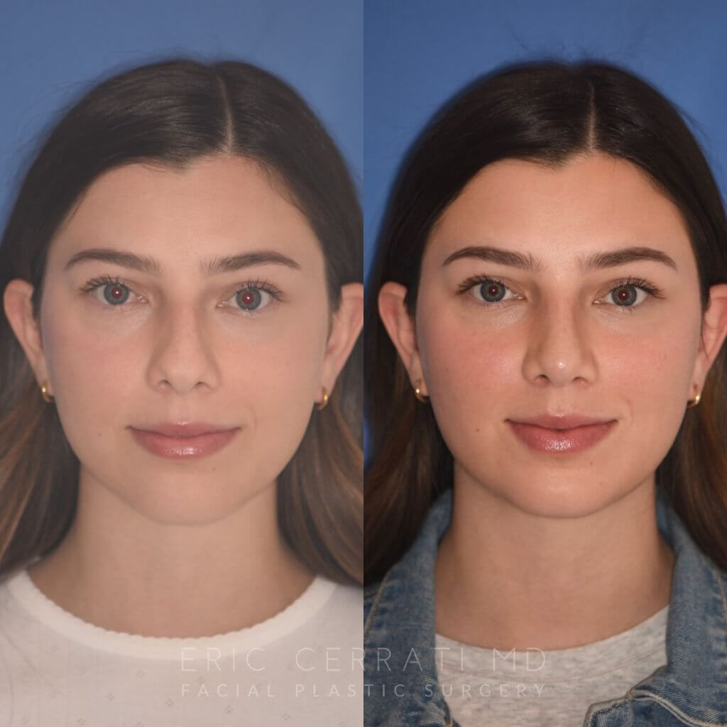 patient before and after rhinoplasty - 24 YR - 2 Months Postop: Rhinoplasty