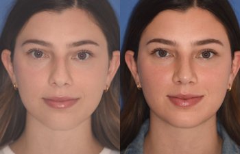 patient before and after rhinoplasty - 24 YR - 2 Months Postop: Rhinoplasty