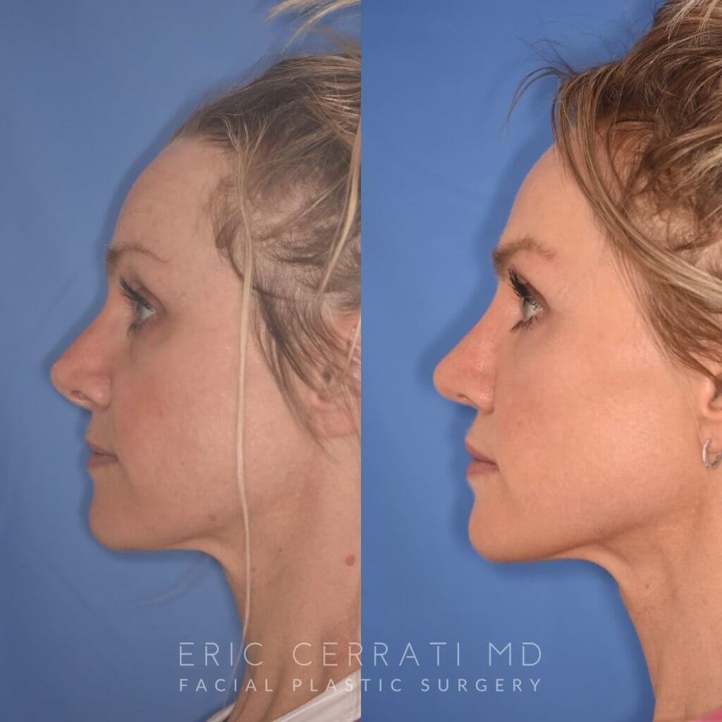 photo of 42 YR patient before and 4 months post op Revision Rhinoplasty