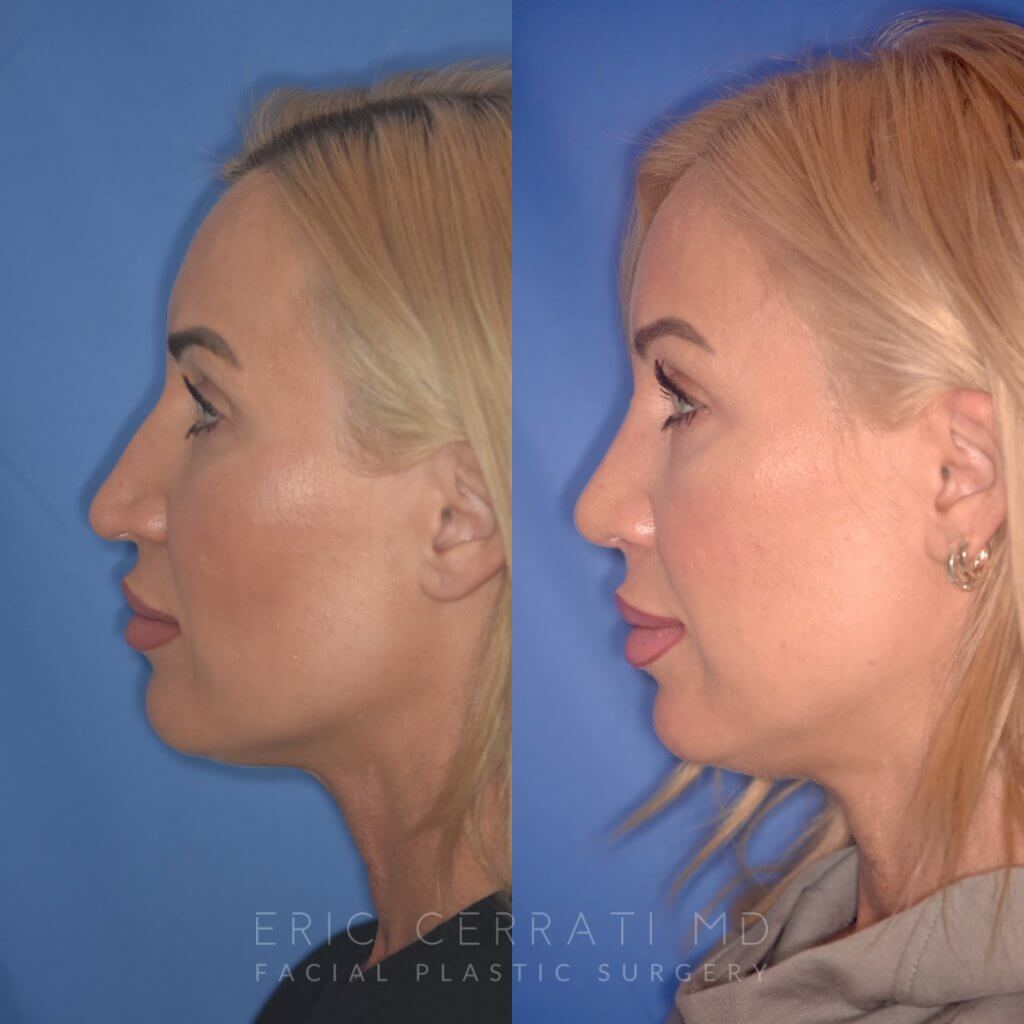 40 YR - 2 Months Postop: Rhinoplasty