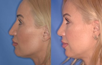 40 YR - 2 Months Postop: Rhinoplasty