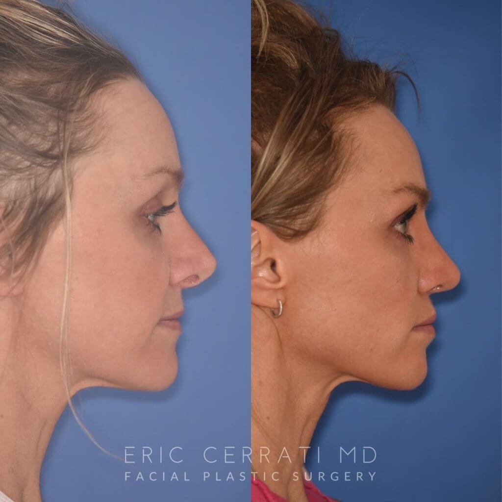 photo of 42 YR patient before and 4 months post op Revision Rhinoplasty
