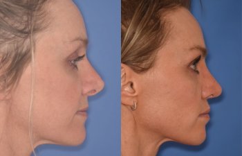 photo of 42 YR patient before and 4 months post op Revision Rhinoplasty