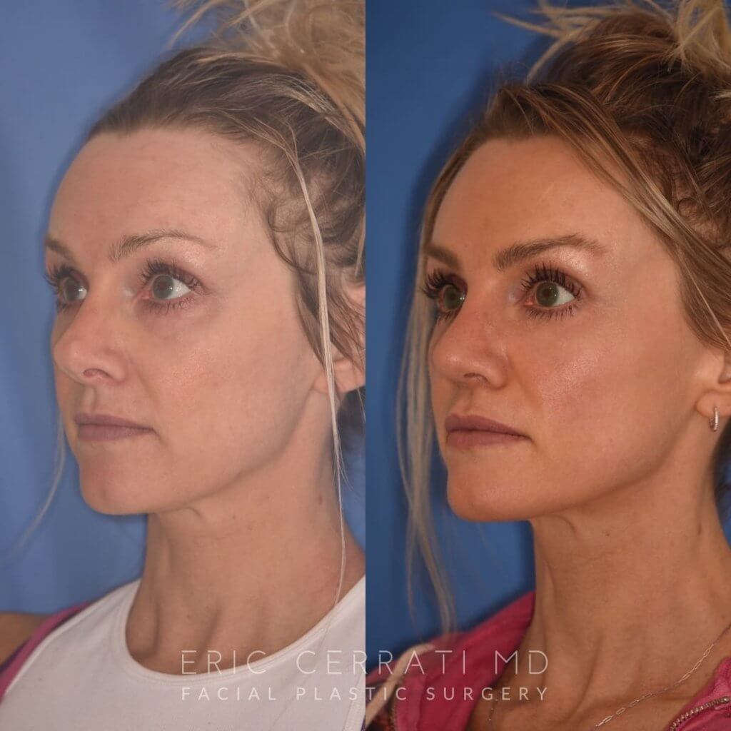 photo of 42 YR patient before and 4 months post op Revision Rhinoplasty