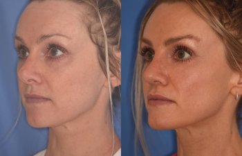 photo of 42 YR patient before and 4 months post op Revision Rhinoplasty