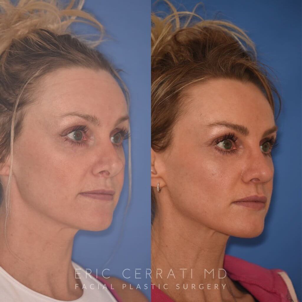photo of 42 YR patient before and 4 months post op Revision Rhinoplasty