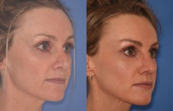 photo of 42 YR patient before and 4 months post op Revision Rhinoplasty