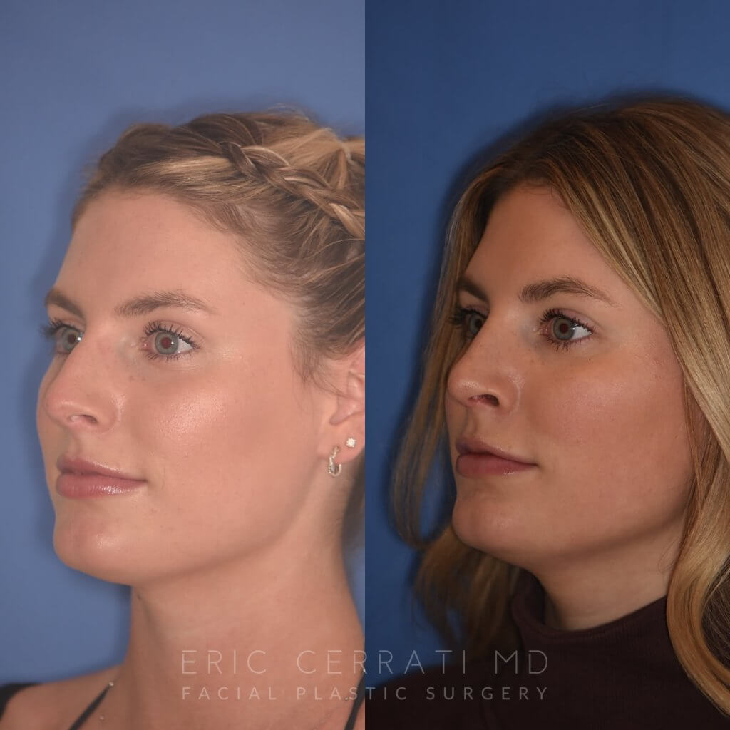 patient before and after rhinoplasty