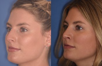 patient before and after rhinoplasty