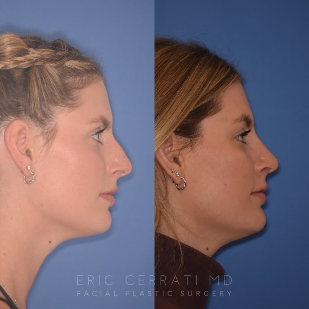 patient before and after rhinoplasty