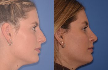 patient before and after rhinoplasty