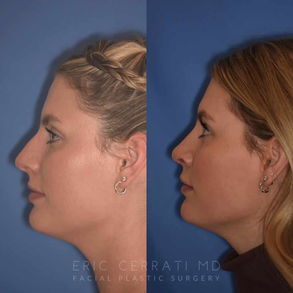 patient before and after rhinoplasty