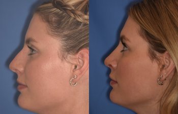 patient before and after rhinoplasty