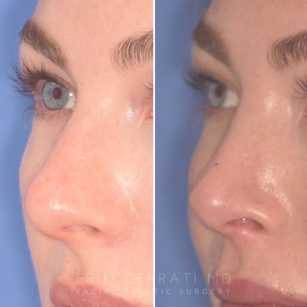 before and after rhinoplasty procedure
