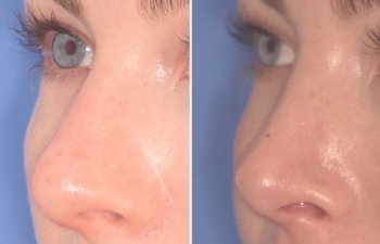 before and after rhinoplasty procedure
