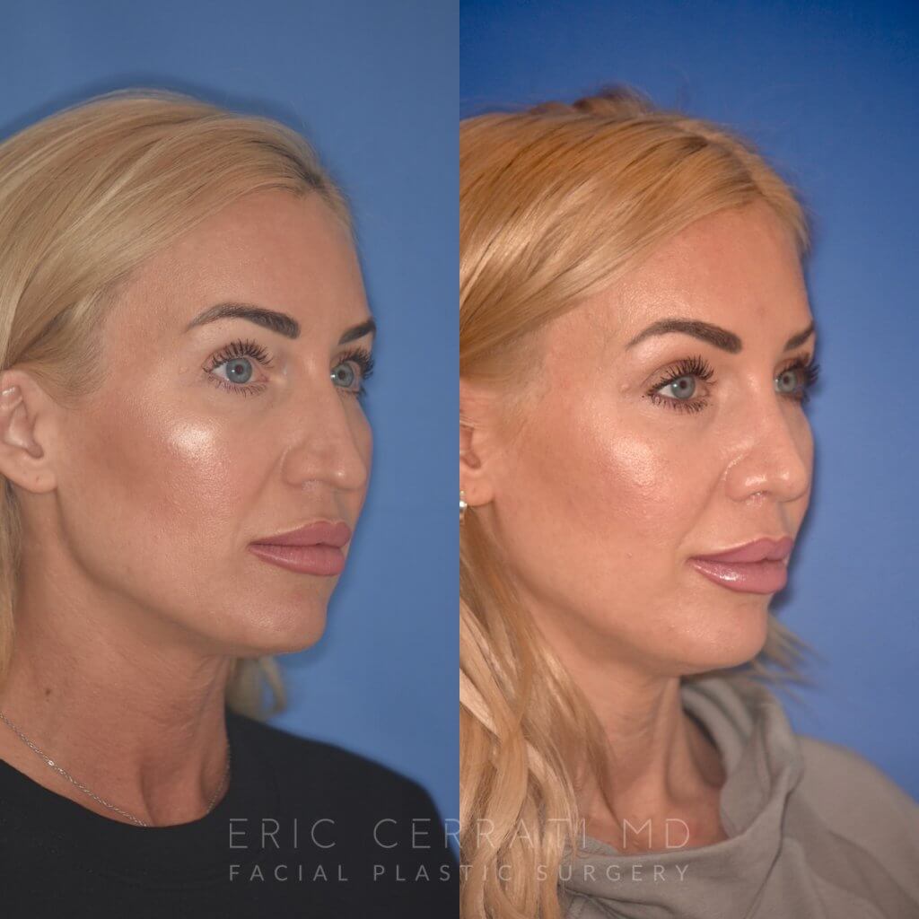 40 YR - 2 Months Postop: Rhinoplasty
