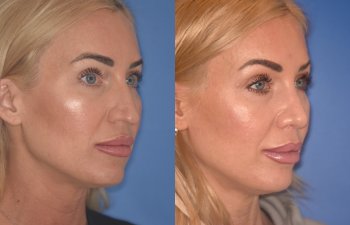 40 YR - 2 Months Postop: Rhinoplasty