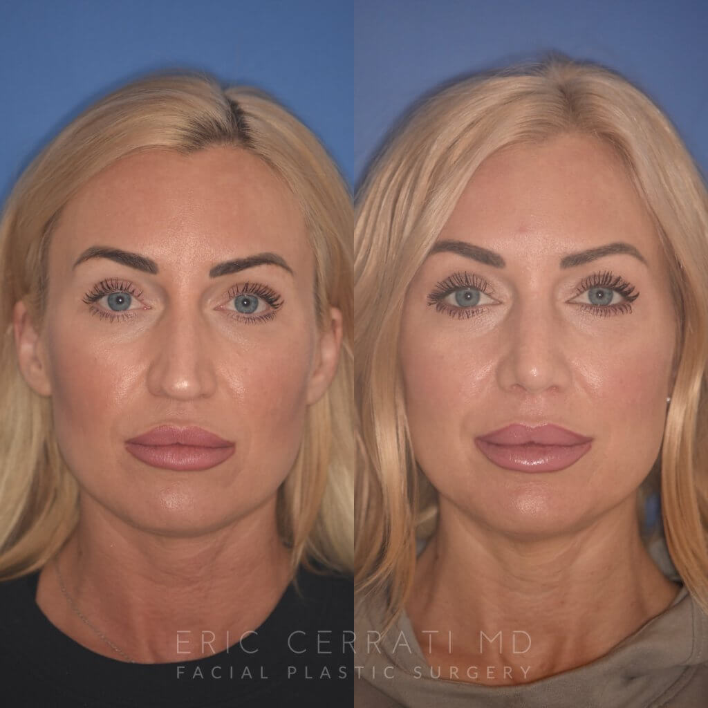 40 YR - 2 Months Postop: Rhinoplasty