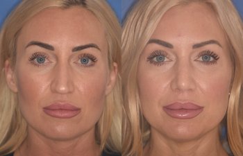 40 YR - 2 Months Postop: Rhinoplasty