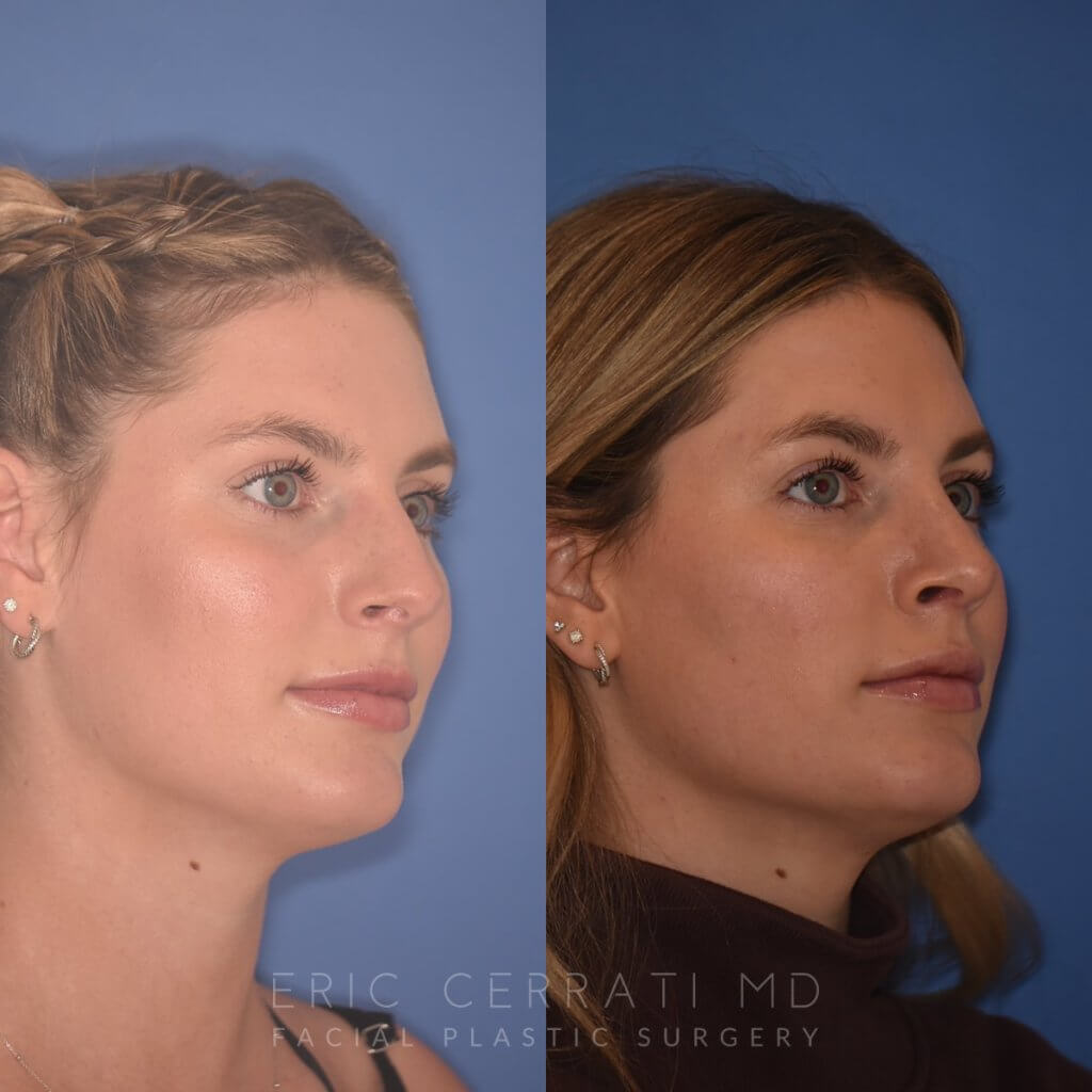 patient before and after rhinoplasty