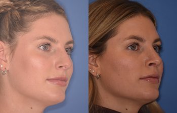 patient before and after rhinoplasty